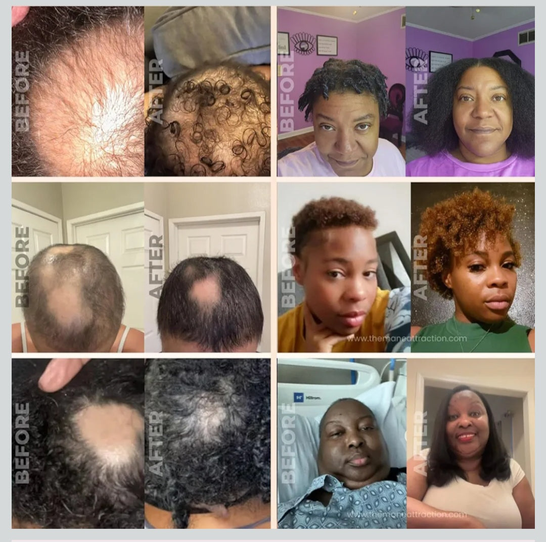 Hair regrowth oil anti-dandruff ant-hair loss hair breakage hair thickener hair soft hair regenerate hair care scalp care margarines oil